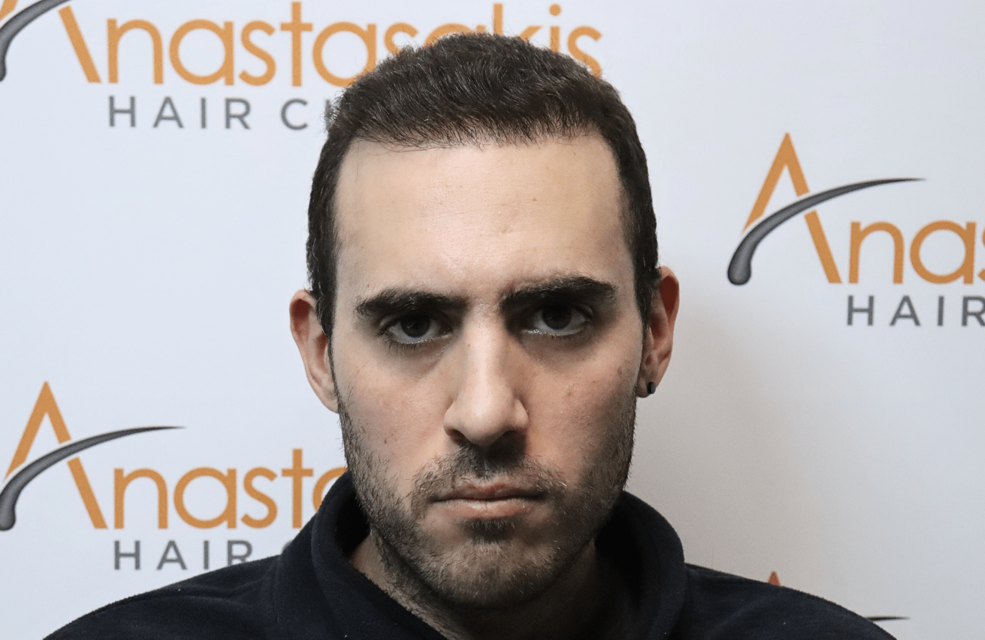 hair transplant result