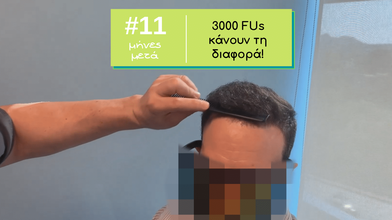 βιντεο ασθενους 11 μηνες μετα τη μεταμόσχευση μαλλιών με 3000 fus