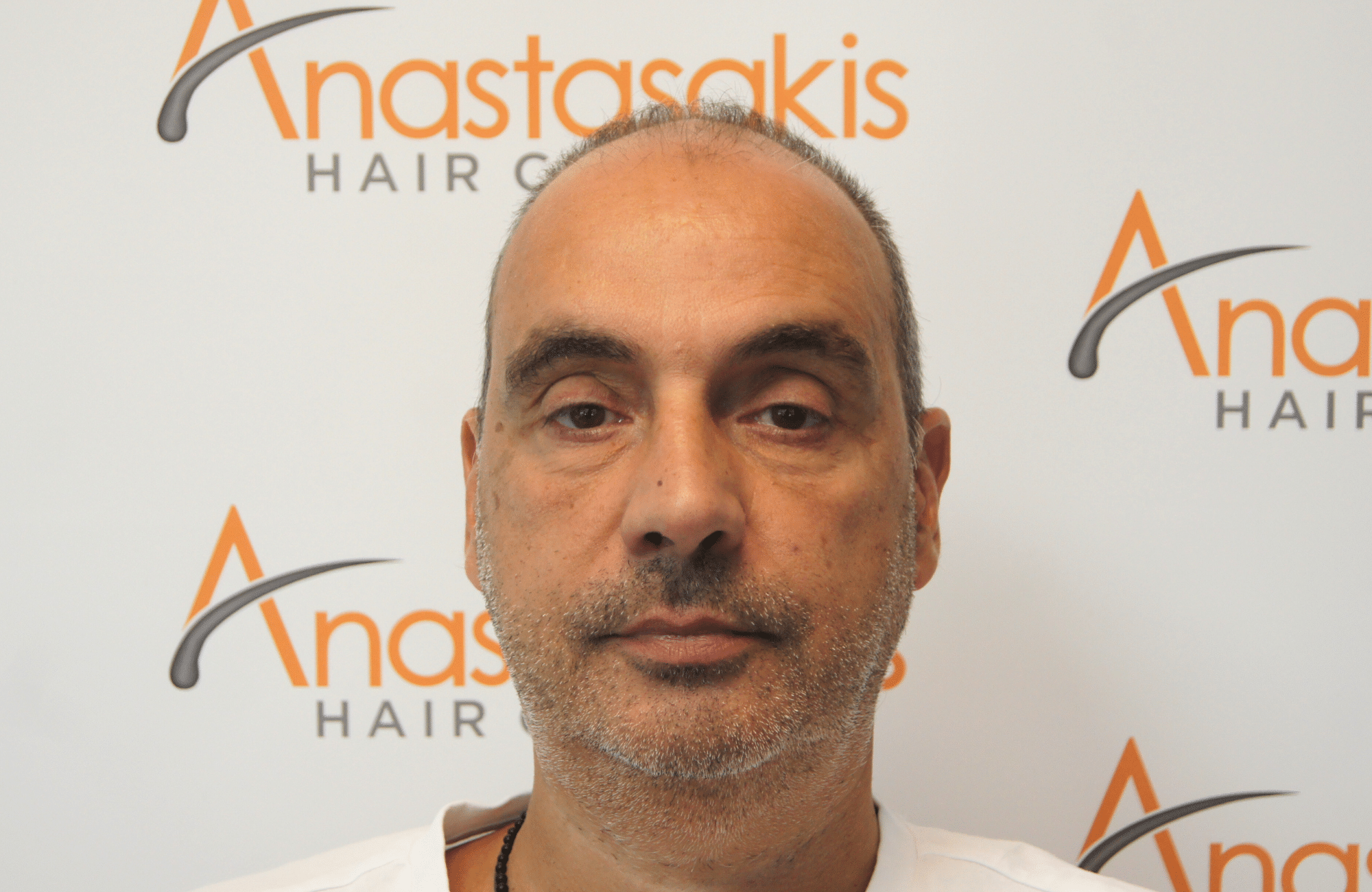 hair transplant5000 fus