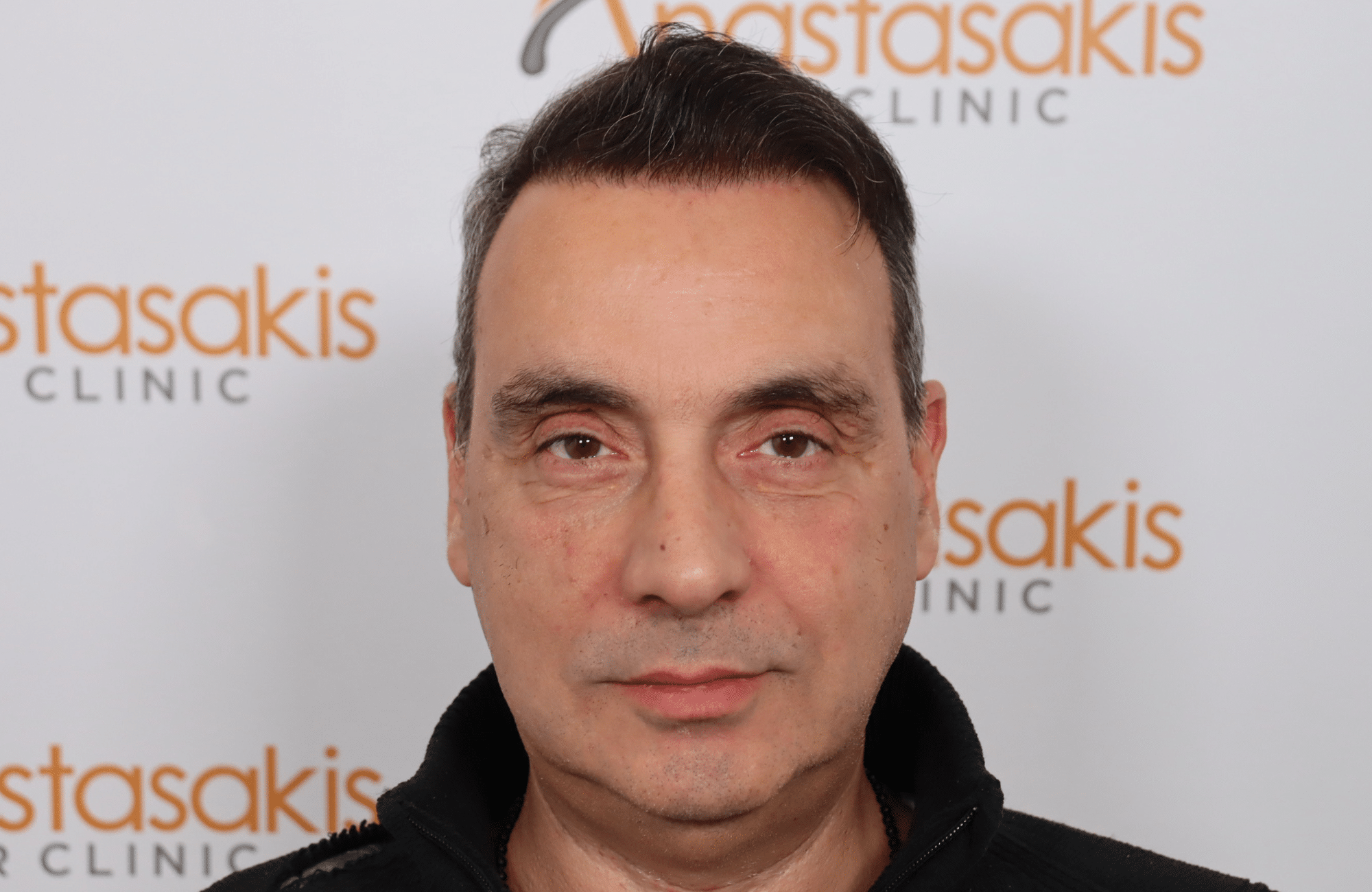 hair transplant5000 fus