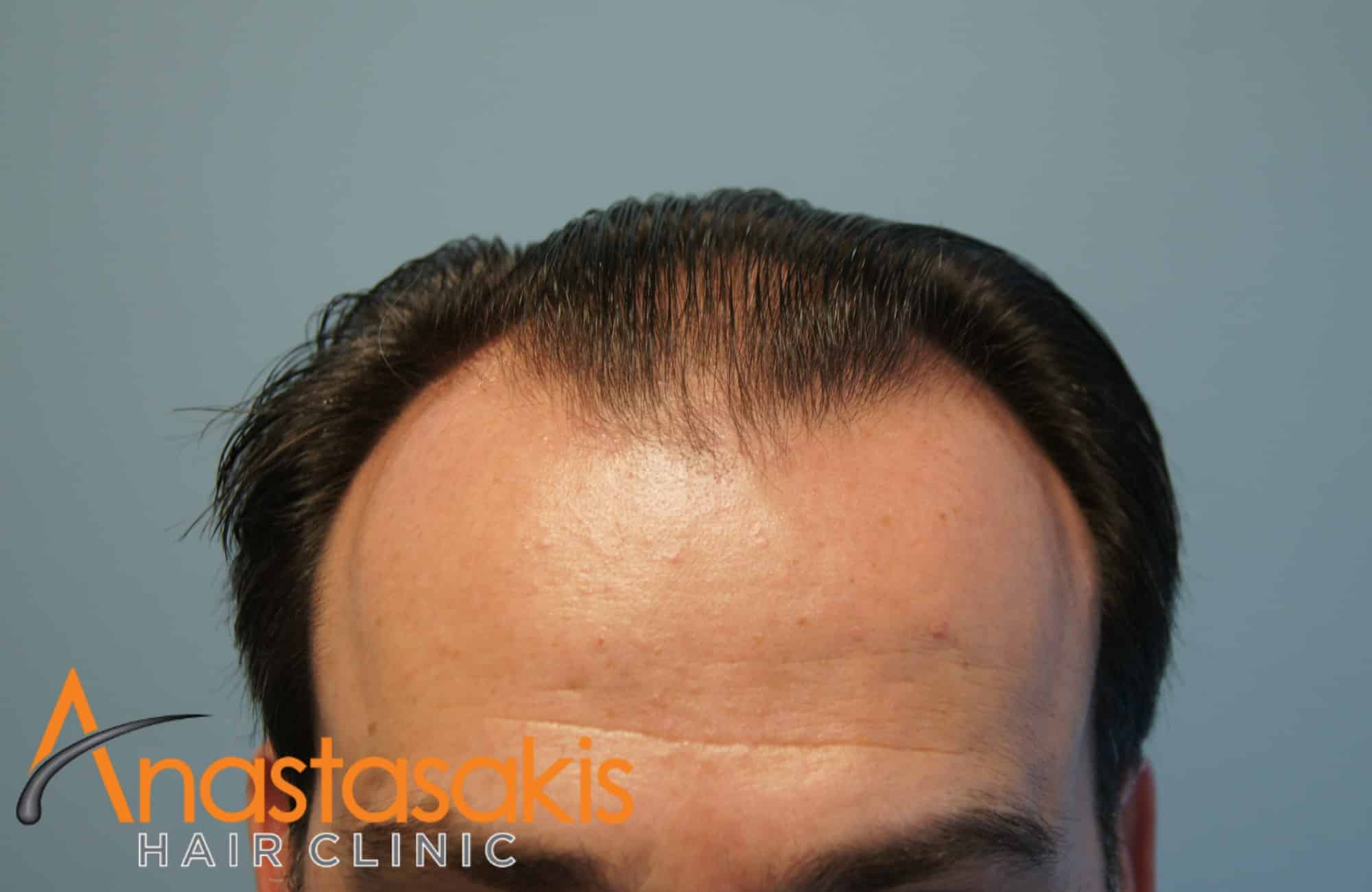 hairline ασθενούς πριν τη μεταμοσχευση μαλλιων με 3500 fus με τη μεθοδο fut