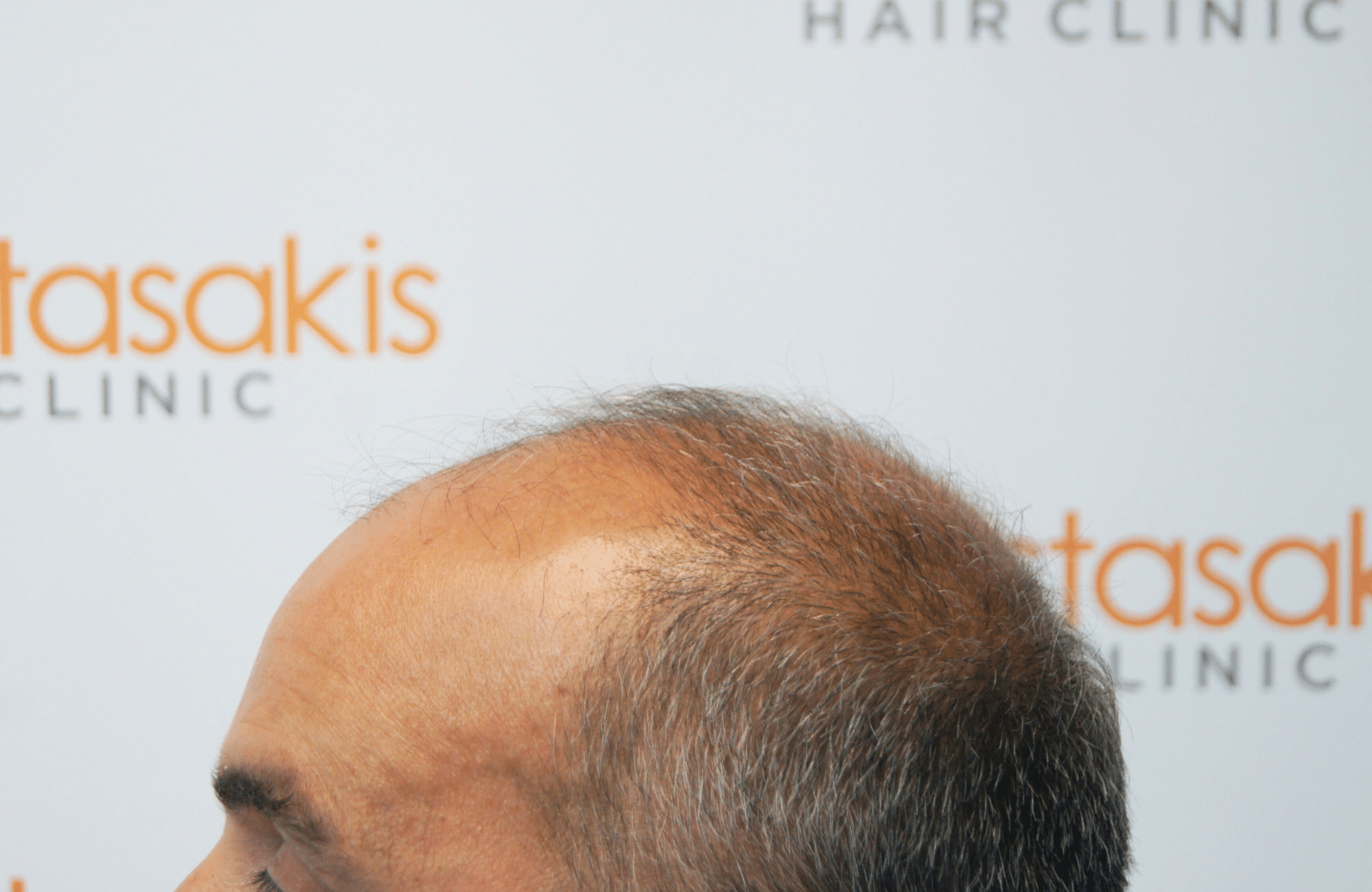 hair transplant5000 fus