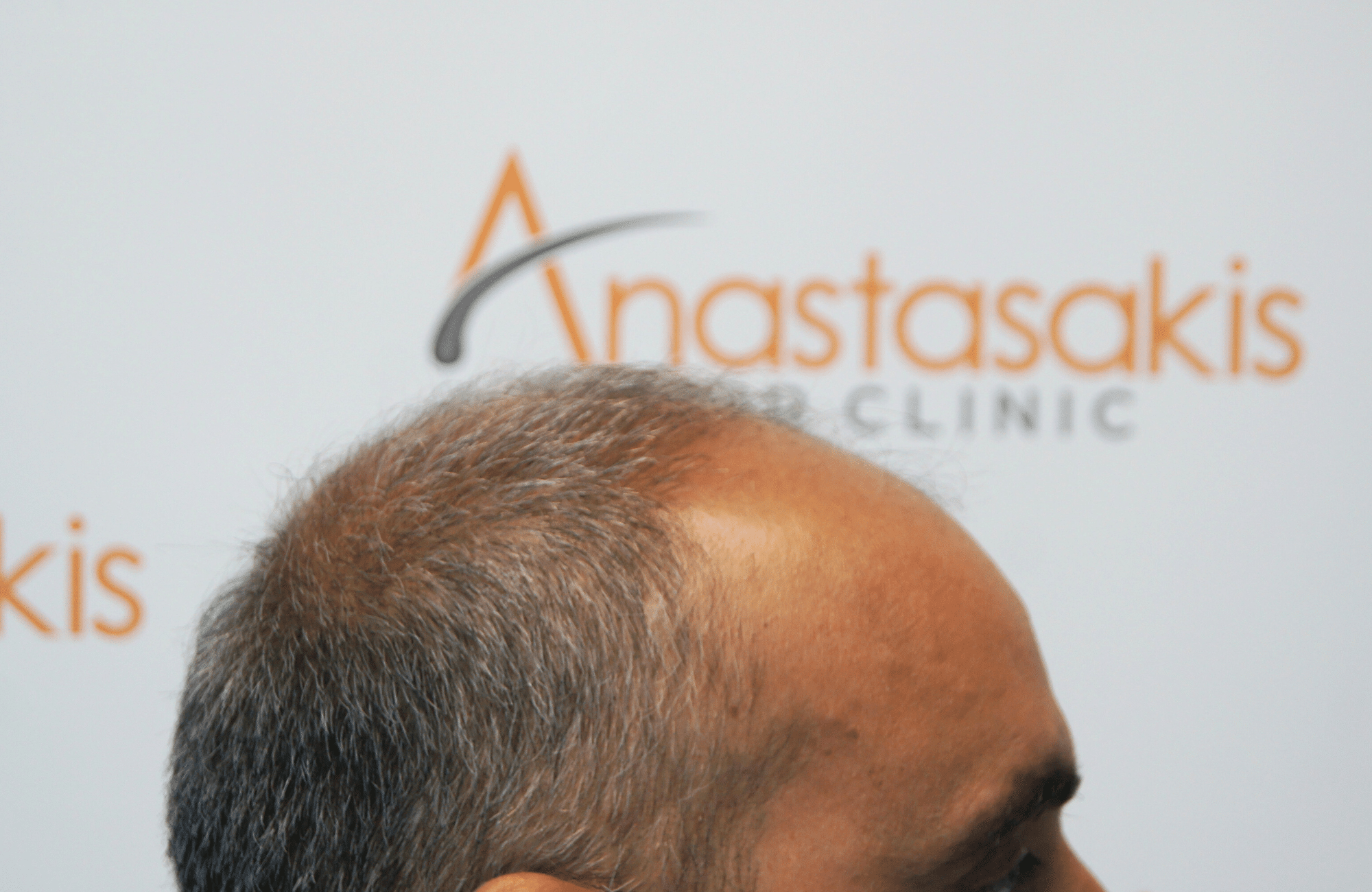 hair transplant5000 fus