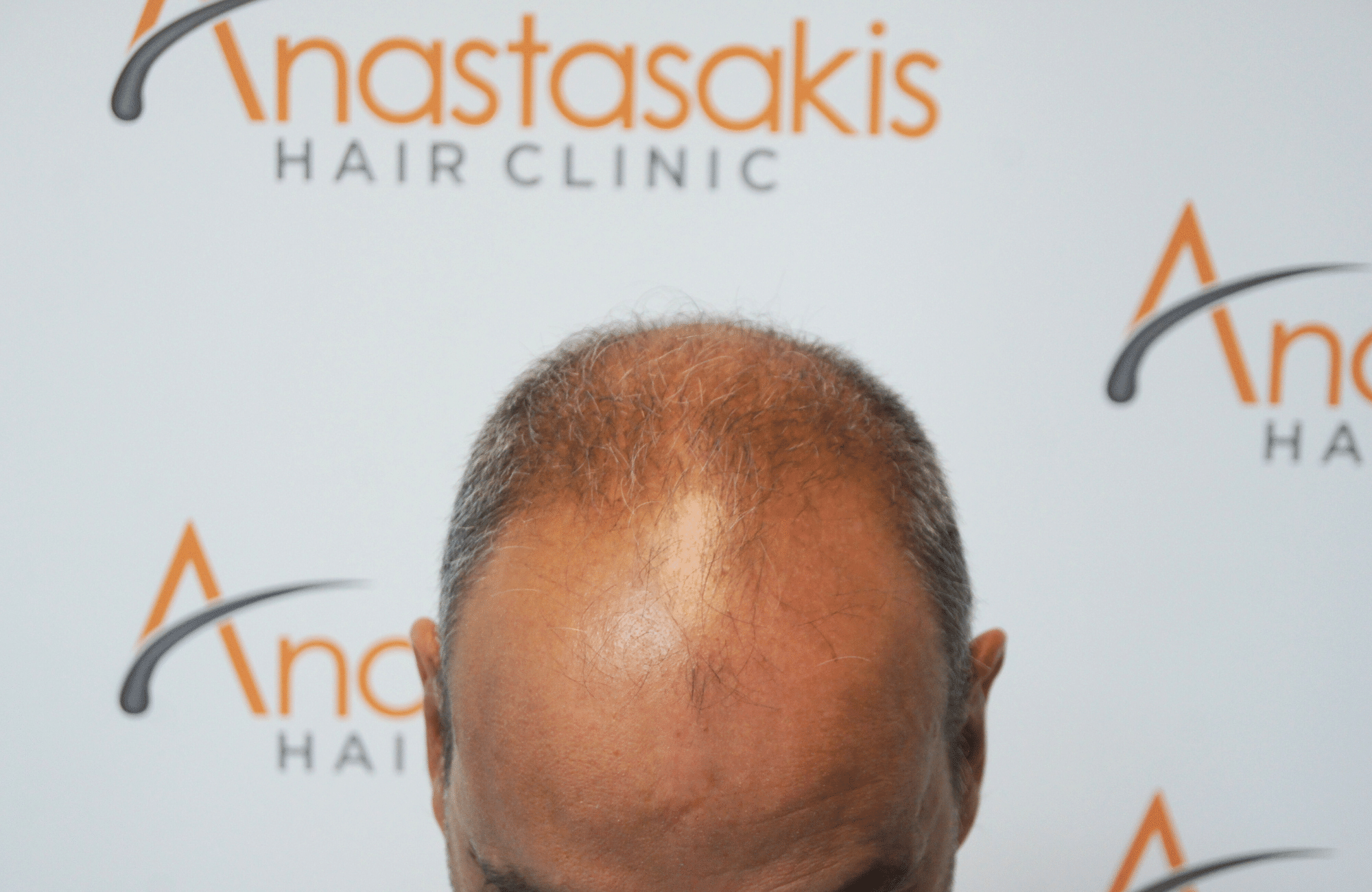 hair transplant5000 fus