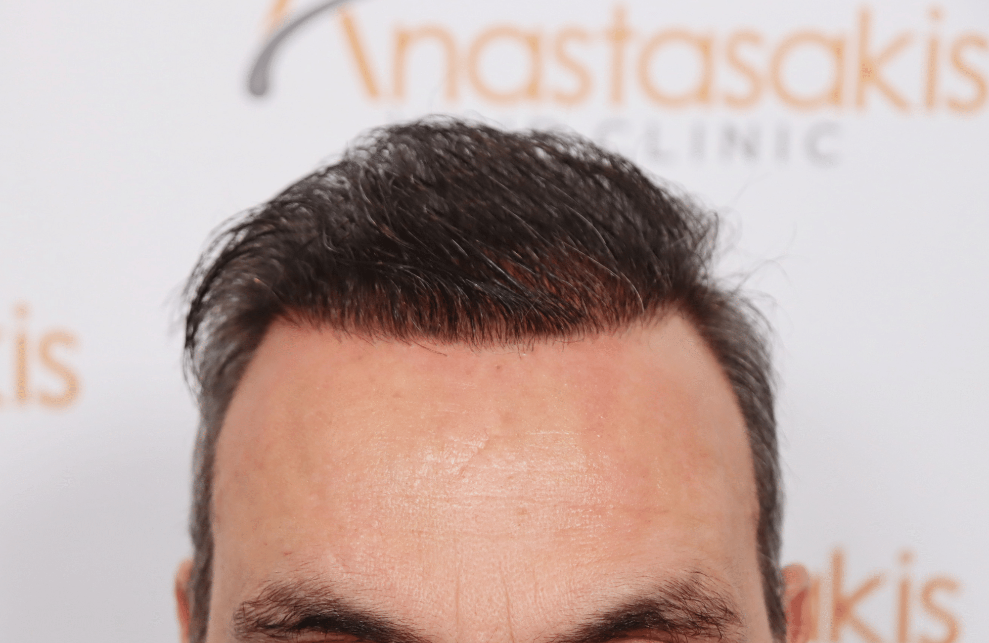 hair transplant5000 fus