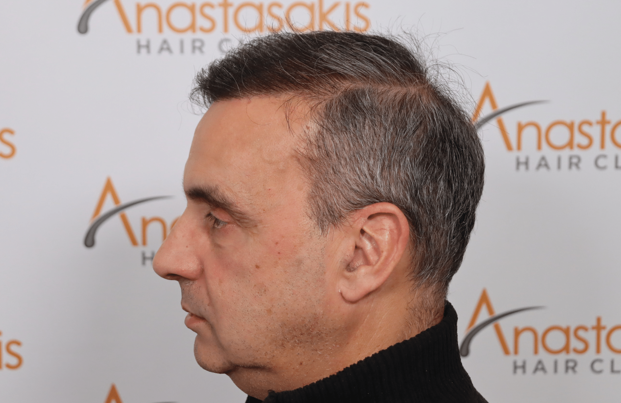 hair transplant5000 fus