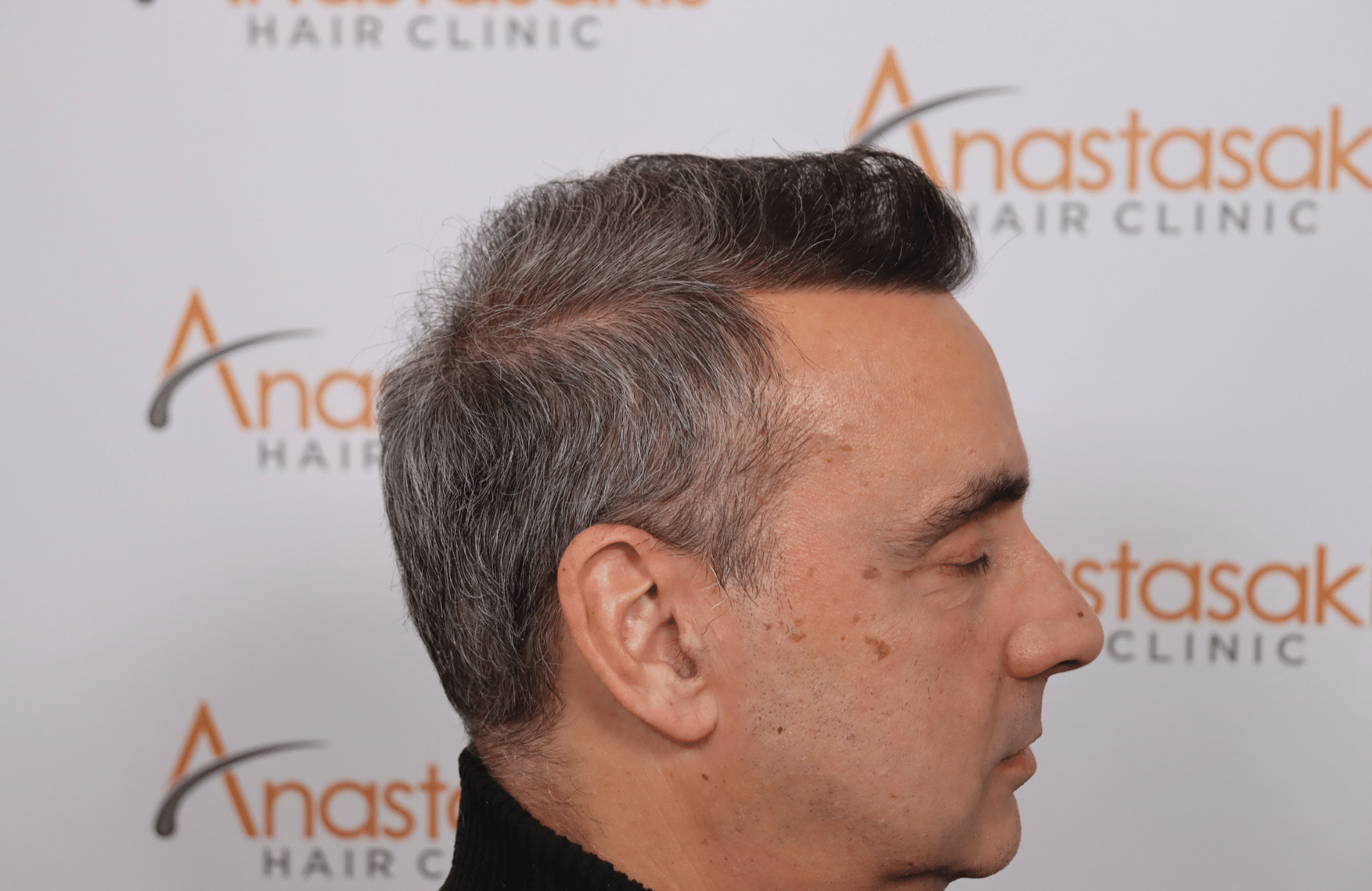 hair transplant5000 fus