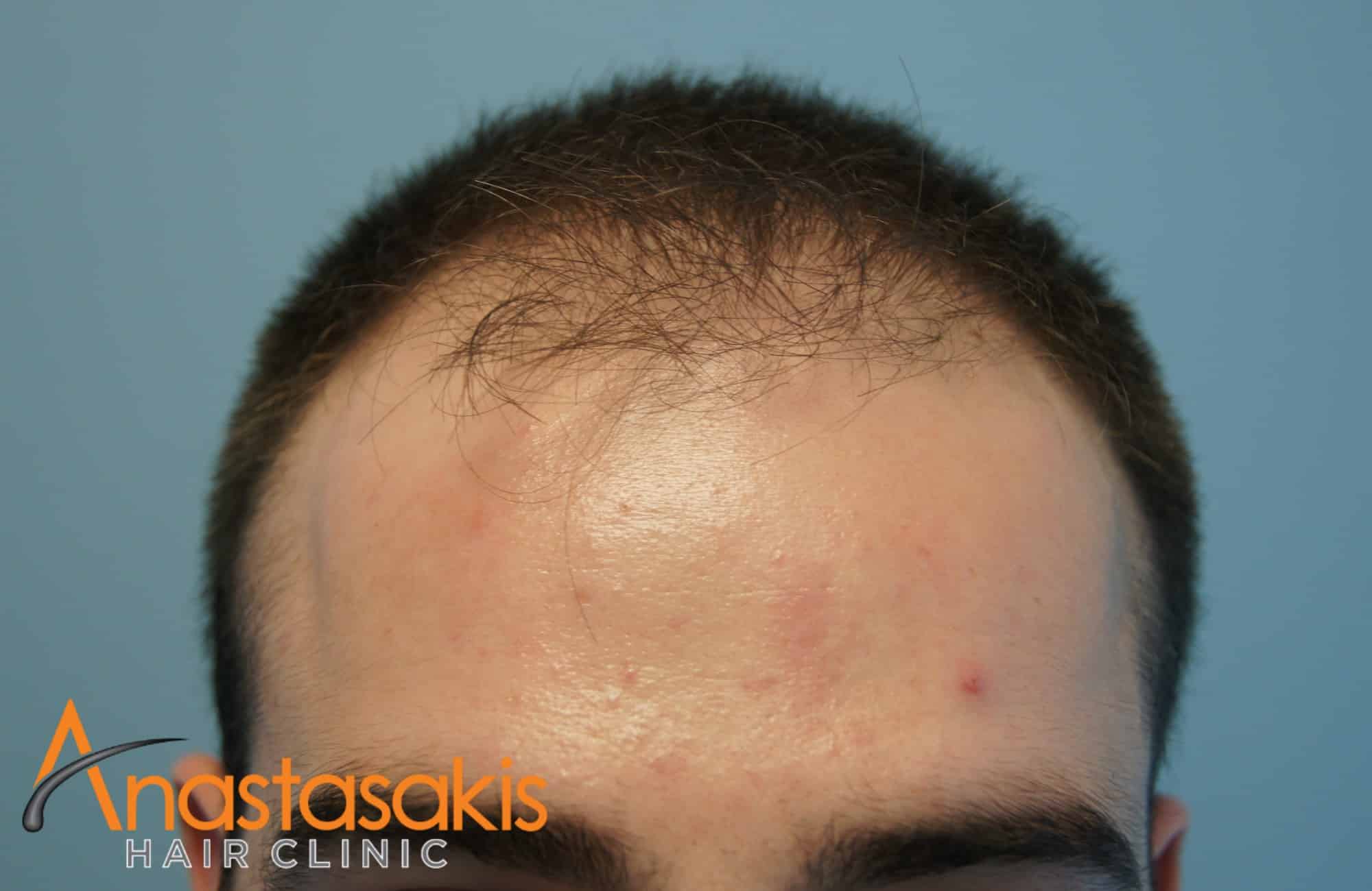 hairline ασθενούς πριν τη μεταμοσχευση μαλλιων με 1500 fus