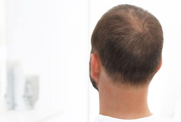 Τελογενής τριχόρροια Anastasakis Hair Clinic
