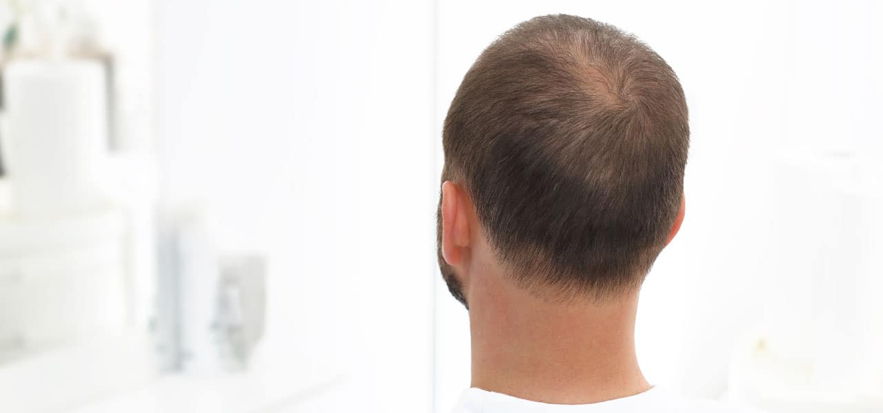 Τελογενής τριχόρροια Anastasakis Hair Clinic