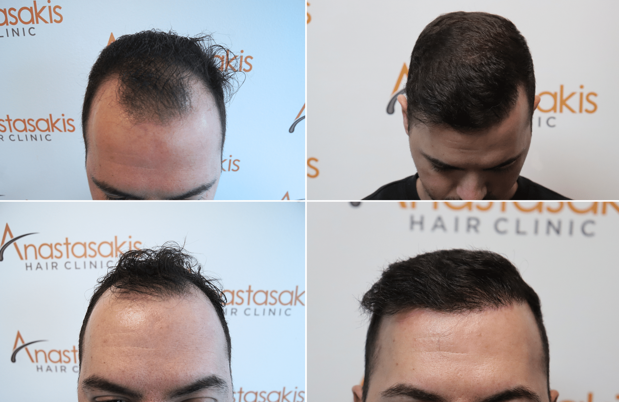 https://www.anastasakishairclinic.gr/portfolio/apotelesma-me-2153-fus/