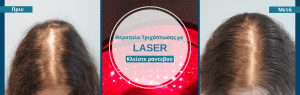 Κλειστε ραντεβου ενημέρωσης για laser τριχόπτωσης