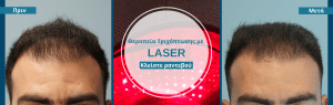 θεραπεία Τριχόπτωσης με laser anastasakis hair clinic