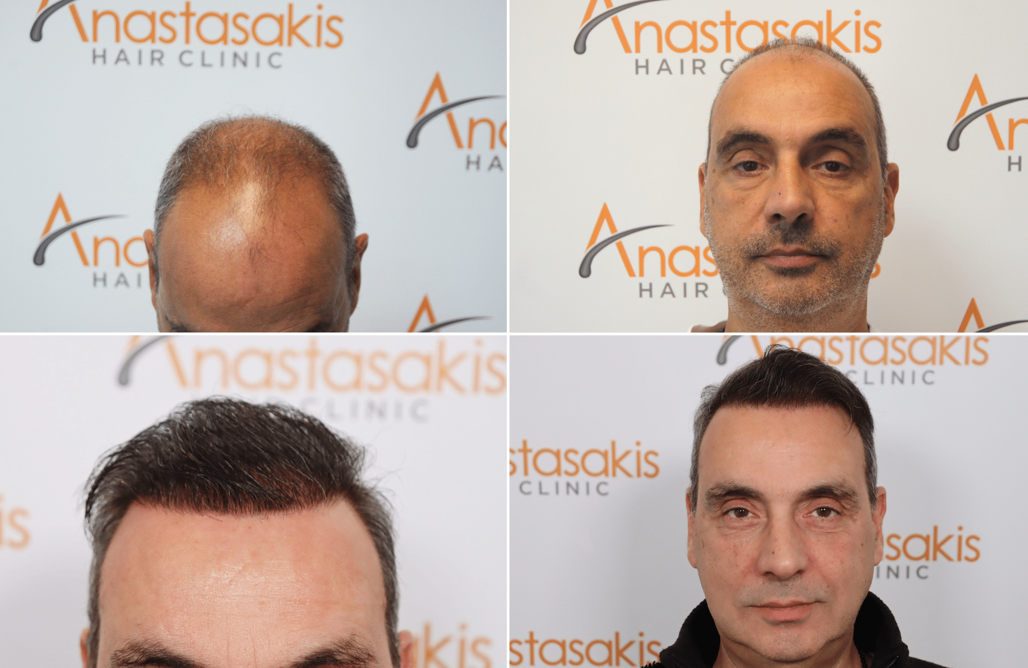 https://www.anastasakishairclinic.gr/portfolio/5000-fus-anastasakis-hair-clinic-result-12months/