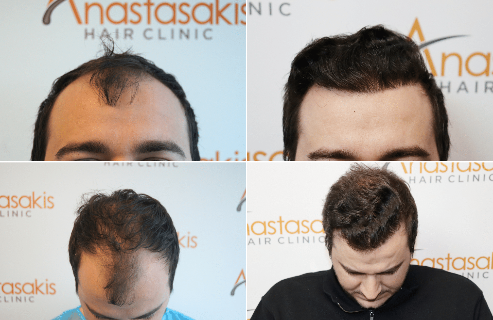 https://www.anastasakishairclinic.gr/portfolio/apotelesma-me-1500fus-fue-anastasakishairclinic/