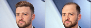 Η τριχόπτωση του Justin Timberlake