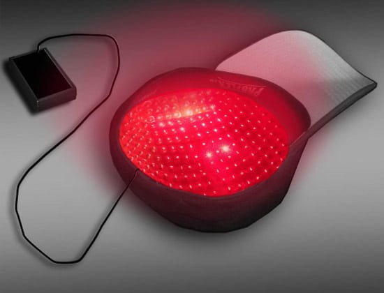 Μαλλιά χωρίς μεταμόσχευση μαλλιών με laser