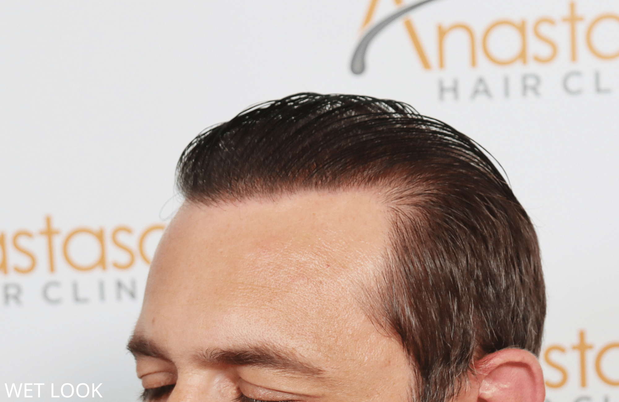 hair transplant result