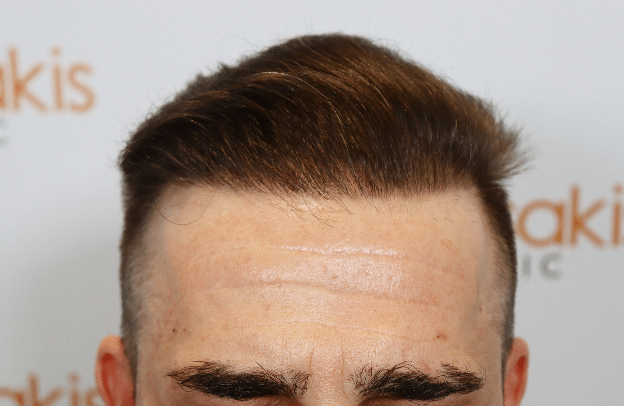 hair transplant result 2500 fus