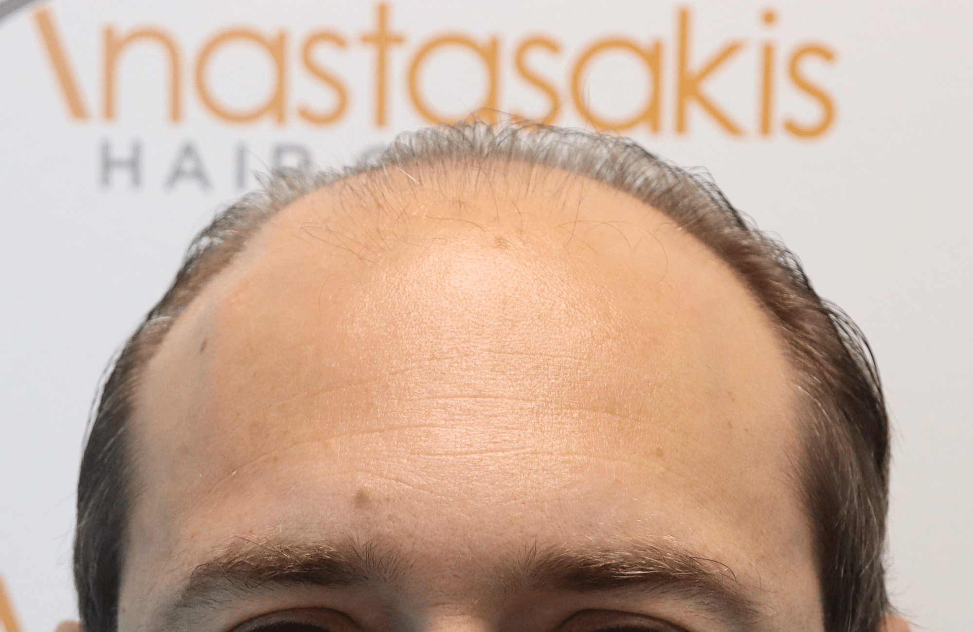 hair transplant result