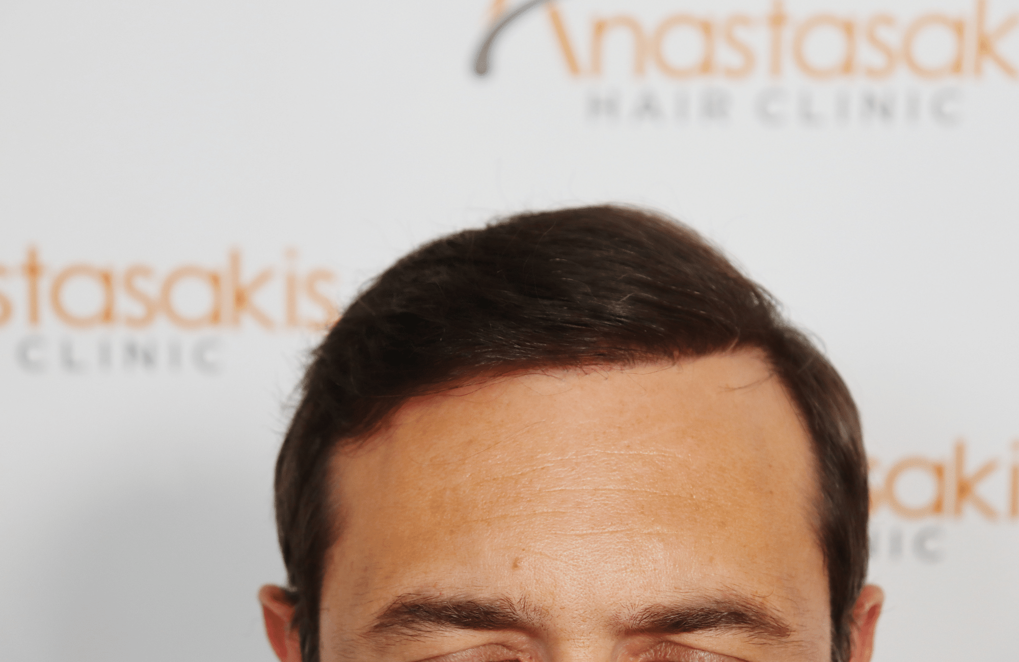 hair transplant result