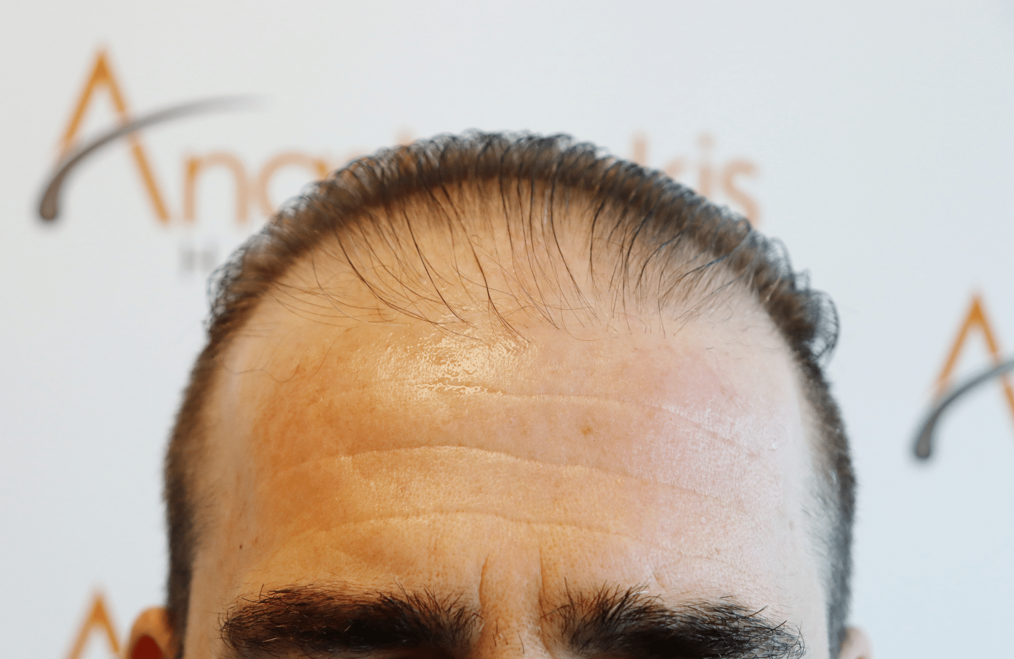 hair transplant result 2500 fus
