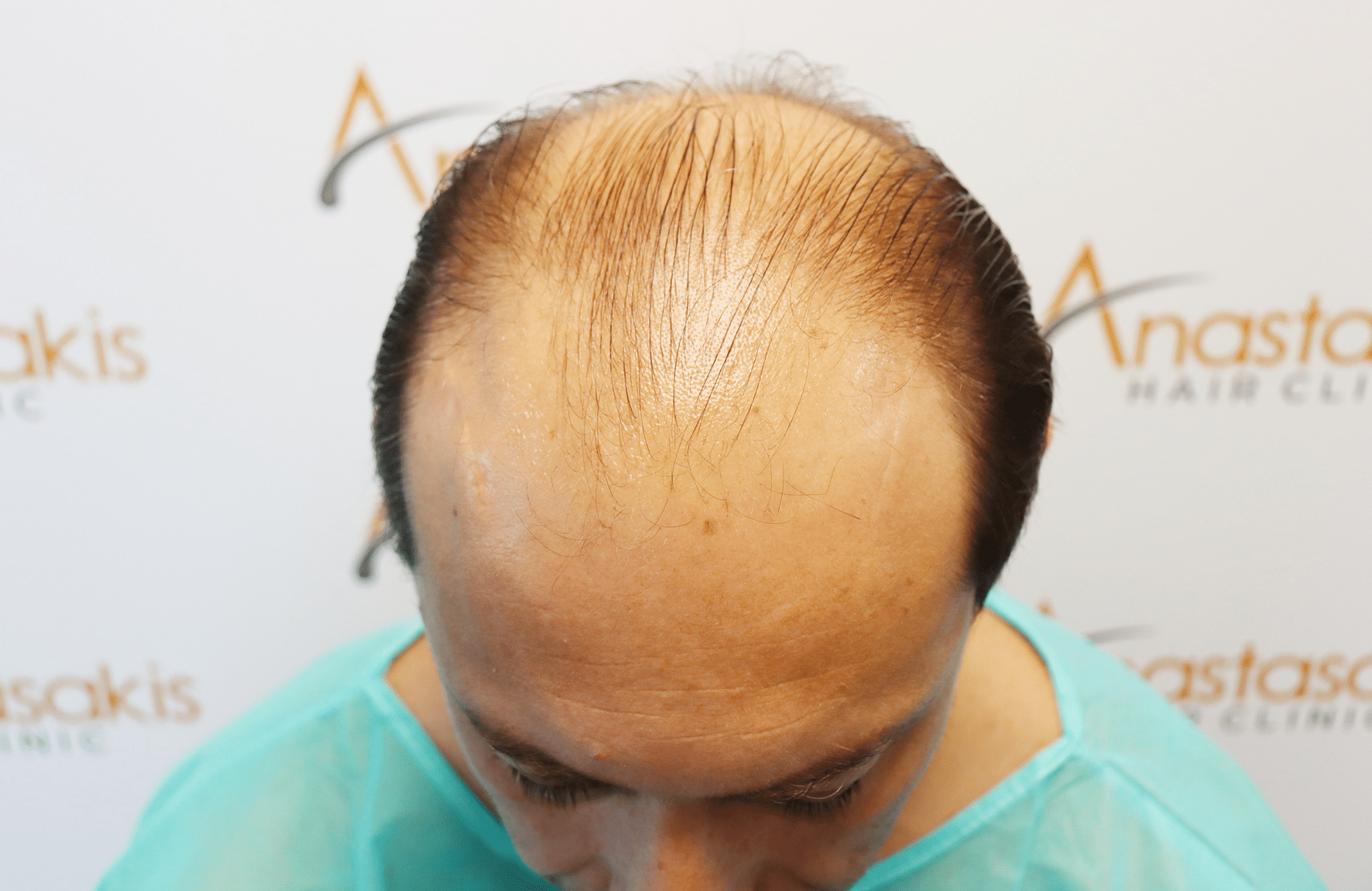 hair transplant result