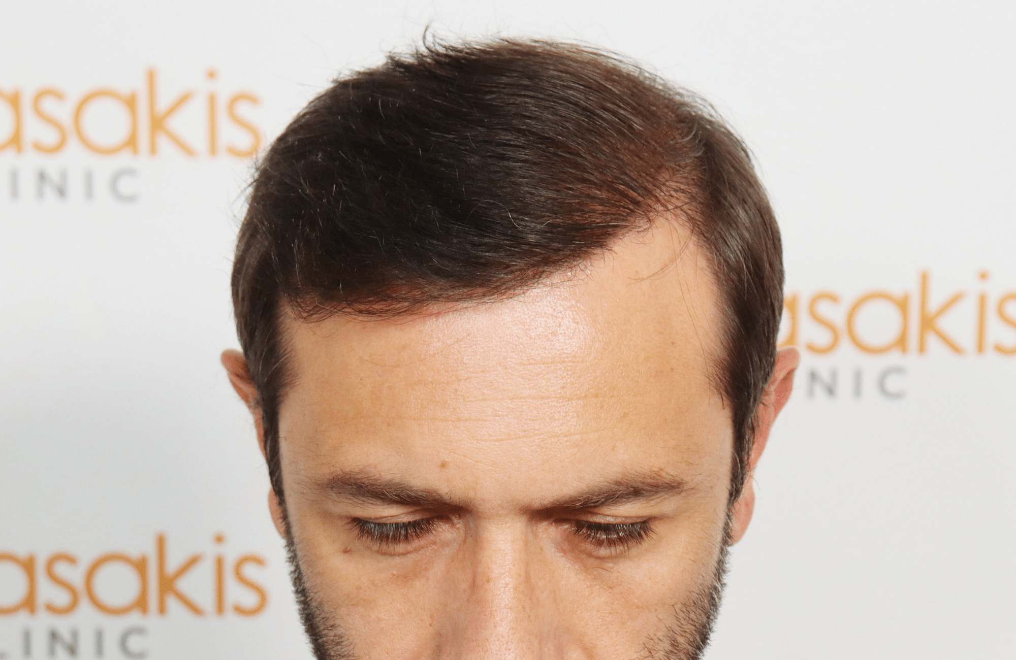 hair transplant result