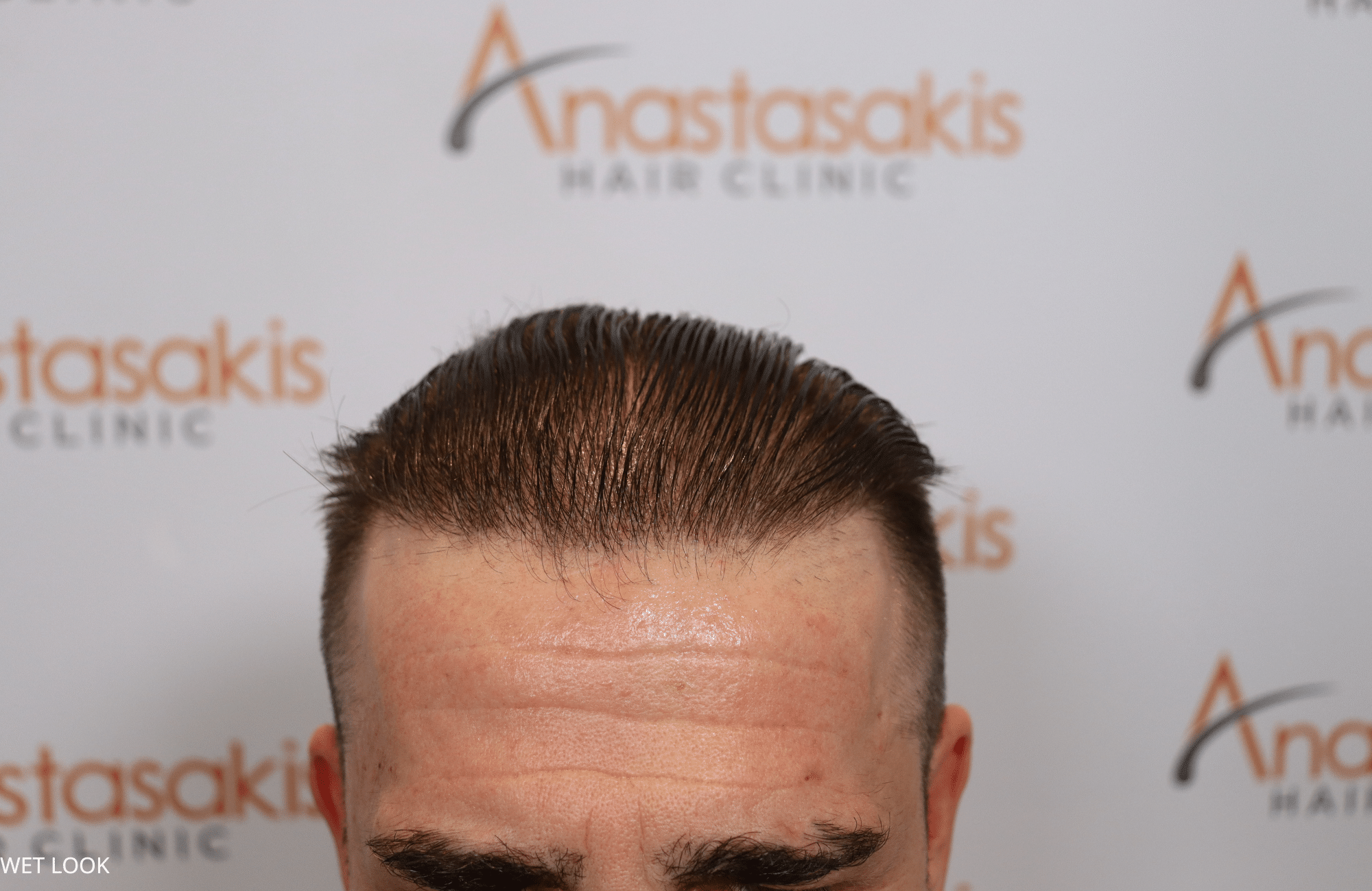 hair transplant result 2500 fus