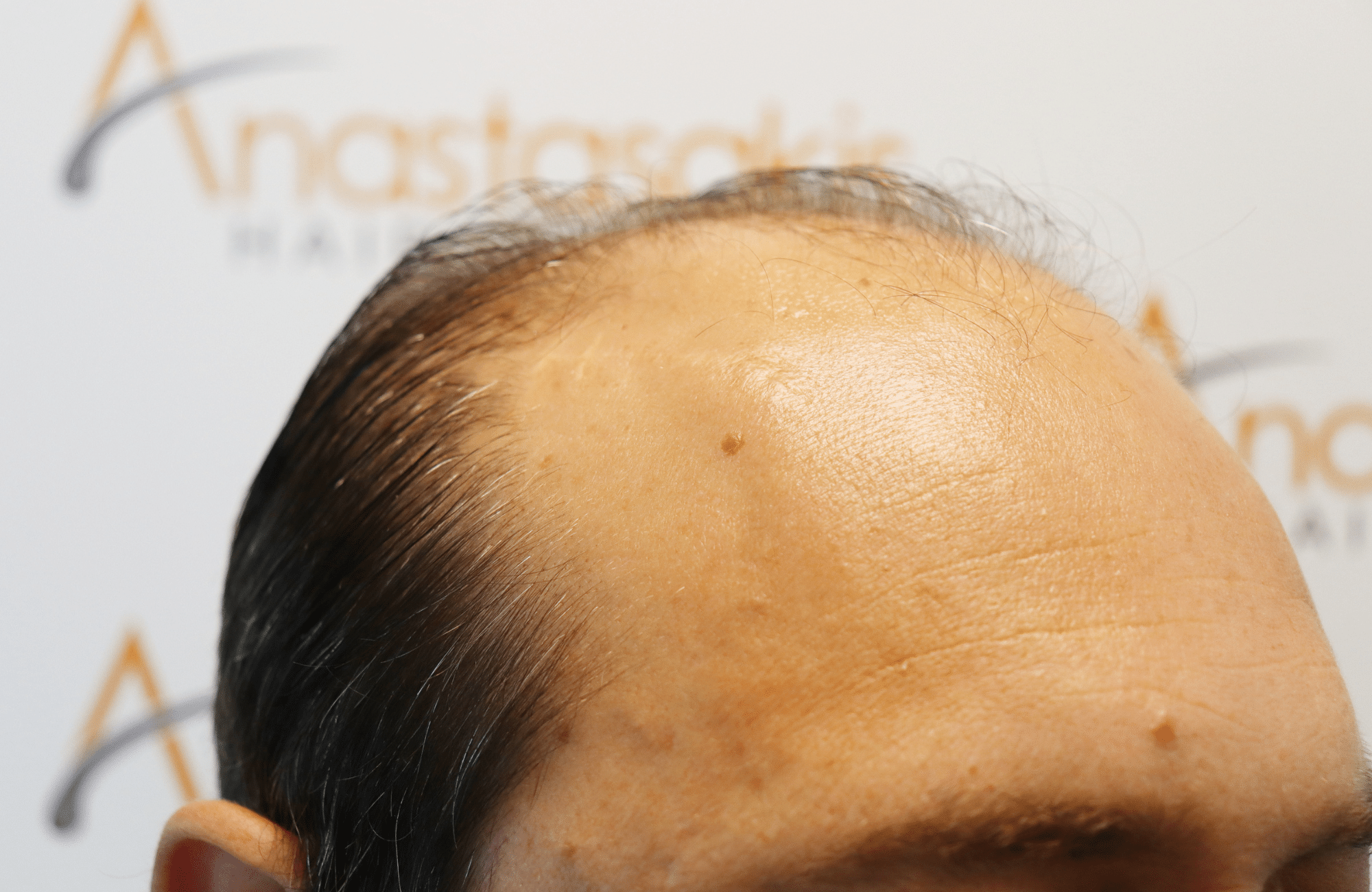 hair transplant result