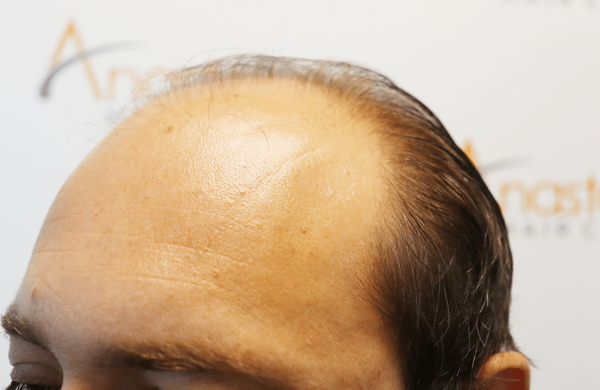 hair transplant result