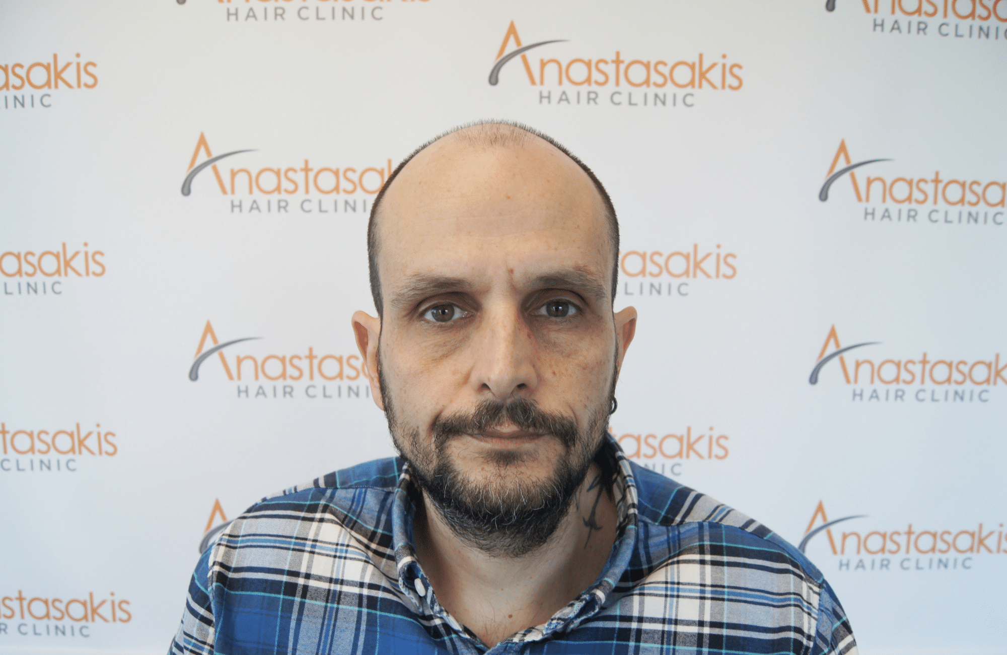 hair transplant result with 4800 follicular units by dr konstantinos anastassakis - fullface before