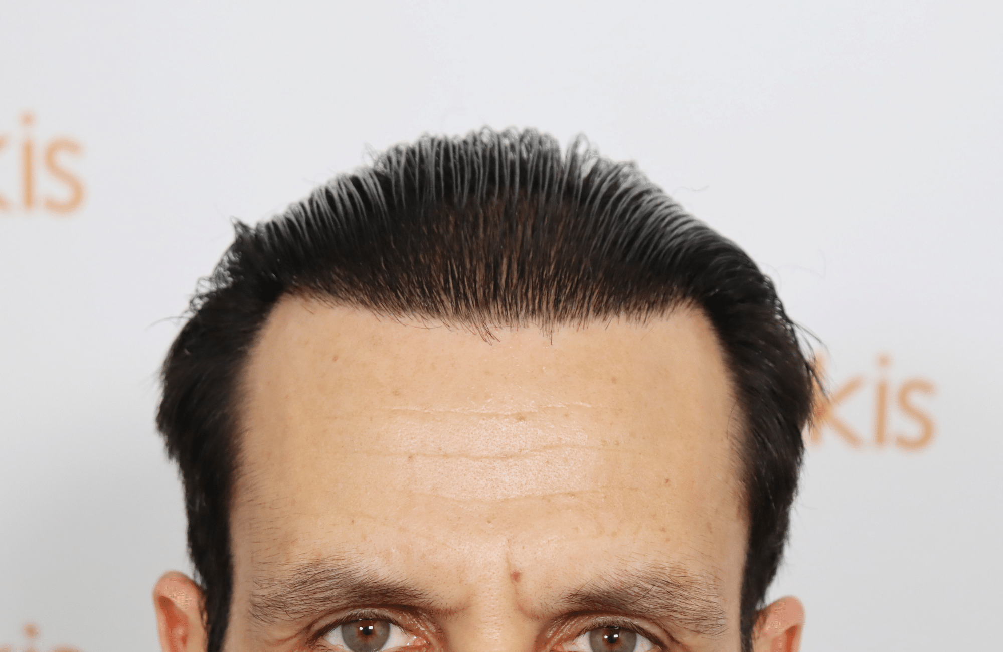 hair transplant result with 4800 follicular units by dr konstantinos anastassakis - hairline after wet look