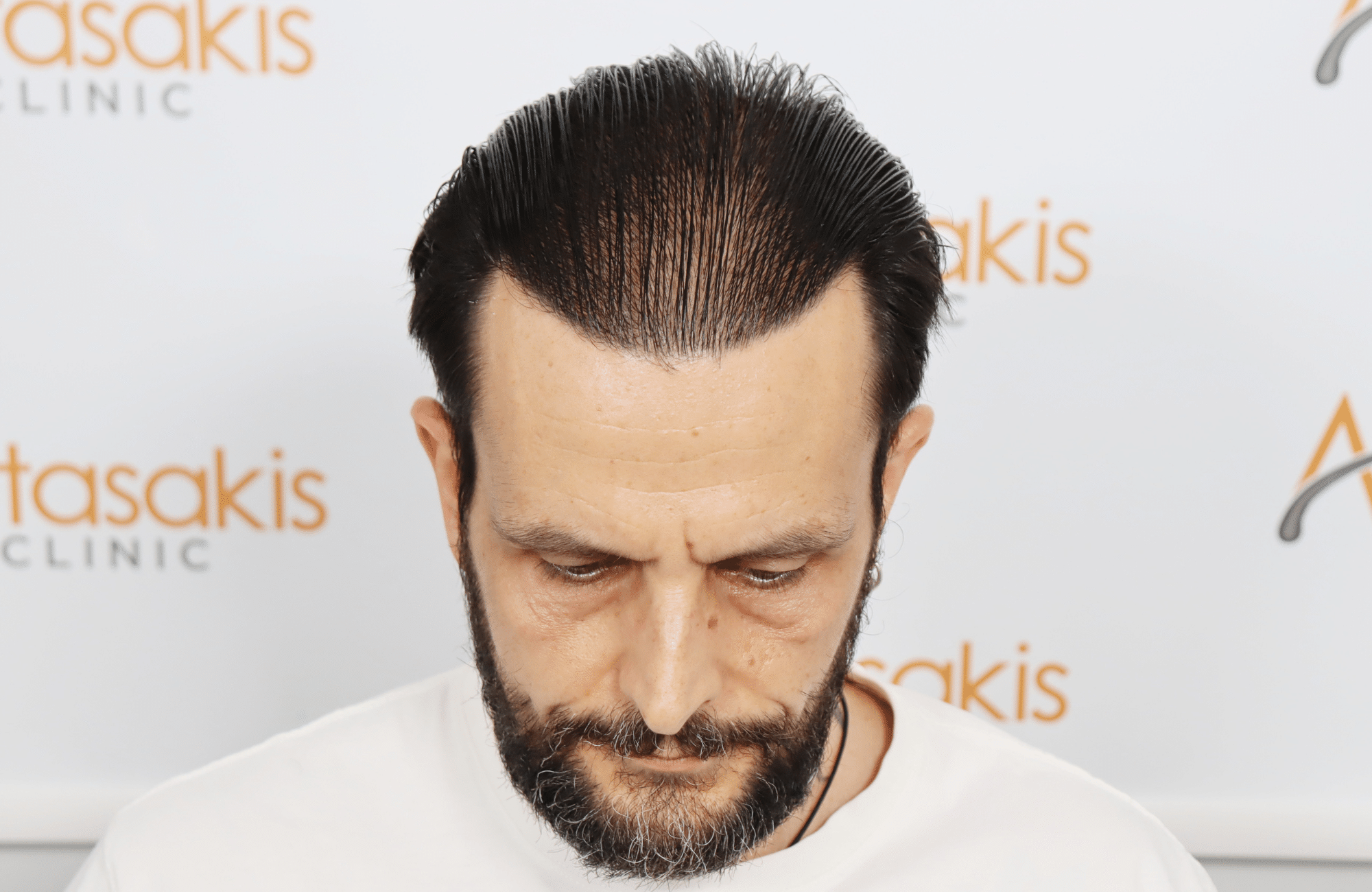 hair transplant result with 4800 follicular units by dr konstantinos anastassakis - midscalp after wet look