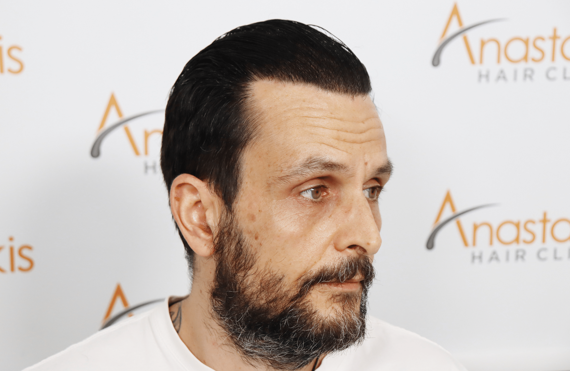 hair transplant result with 4800 follicular units by dr konstantinos anastassakis - side2 after wet look
