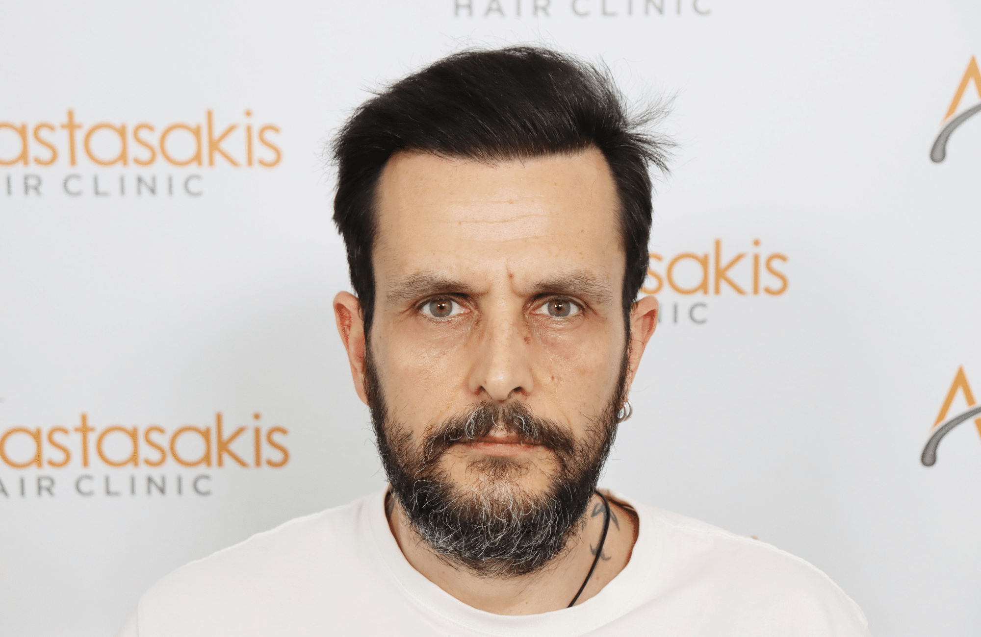 hair transplant result with 4800 follicular units by dr konstantinos anastassakis - fullface after