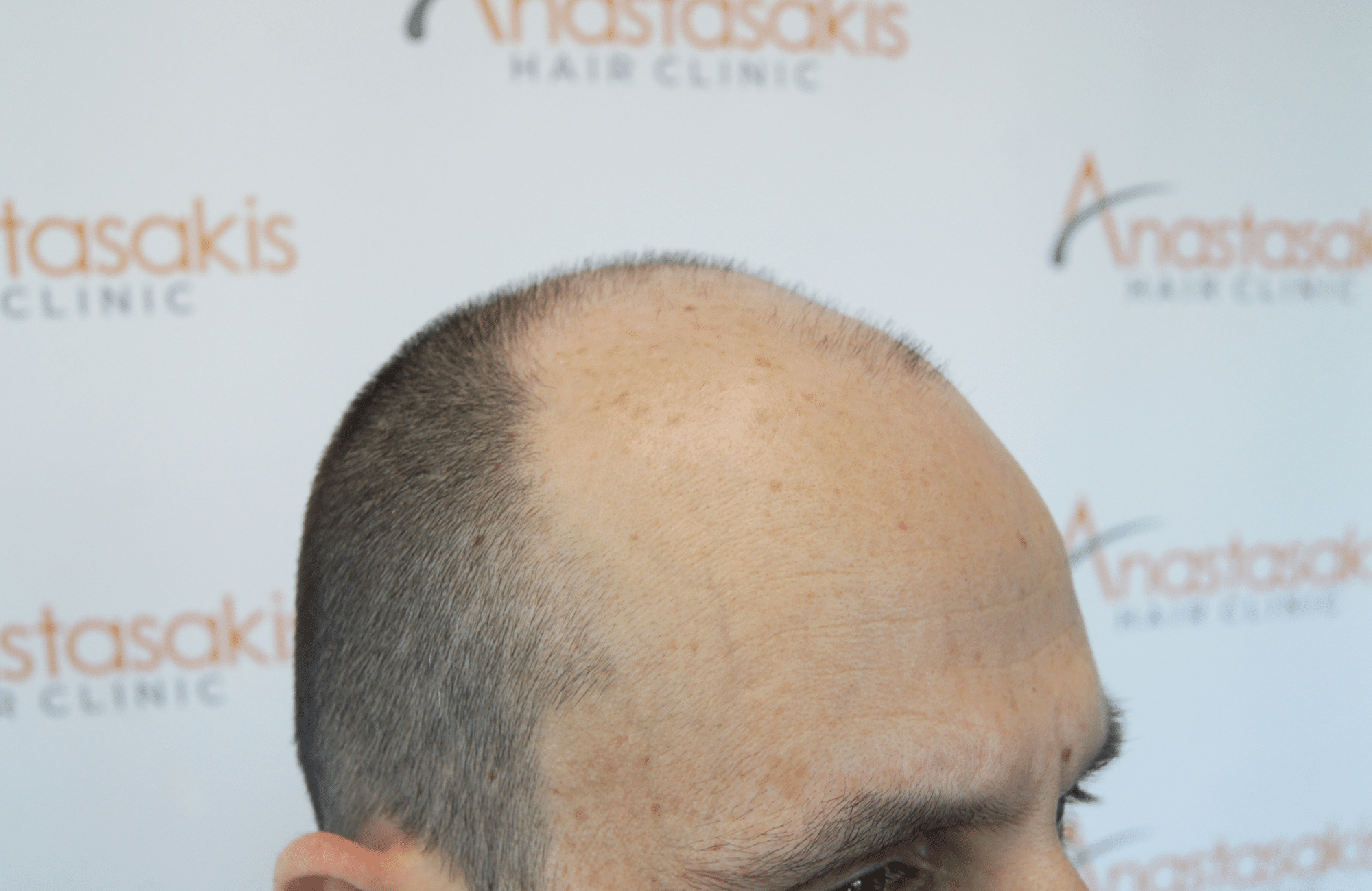 hair transplant result with 4800 follicular units by dr konstantinos anastassakis - side1 before