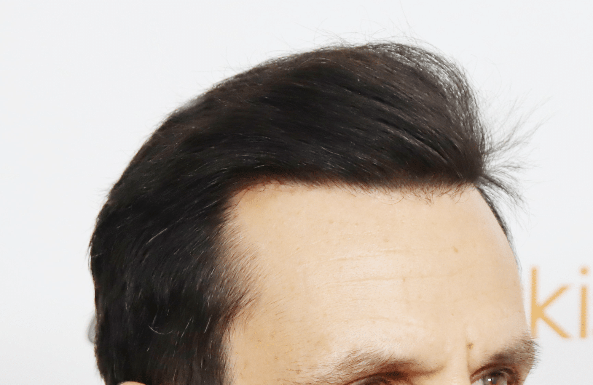 hair transplant result with 4800 follicular units by dr konstantinos anastassakis - side1 after