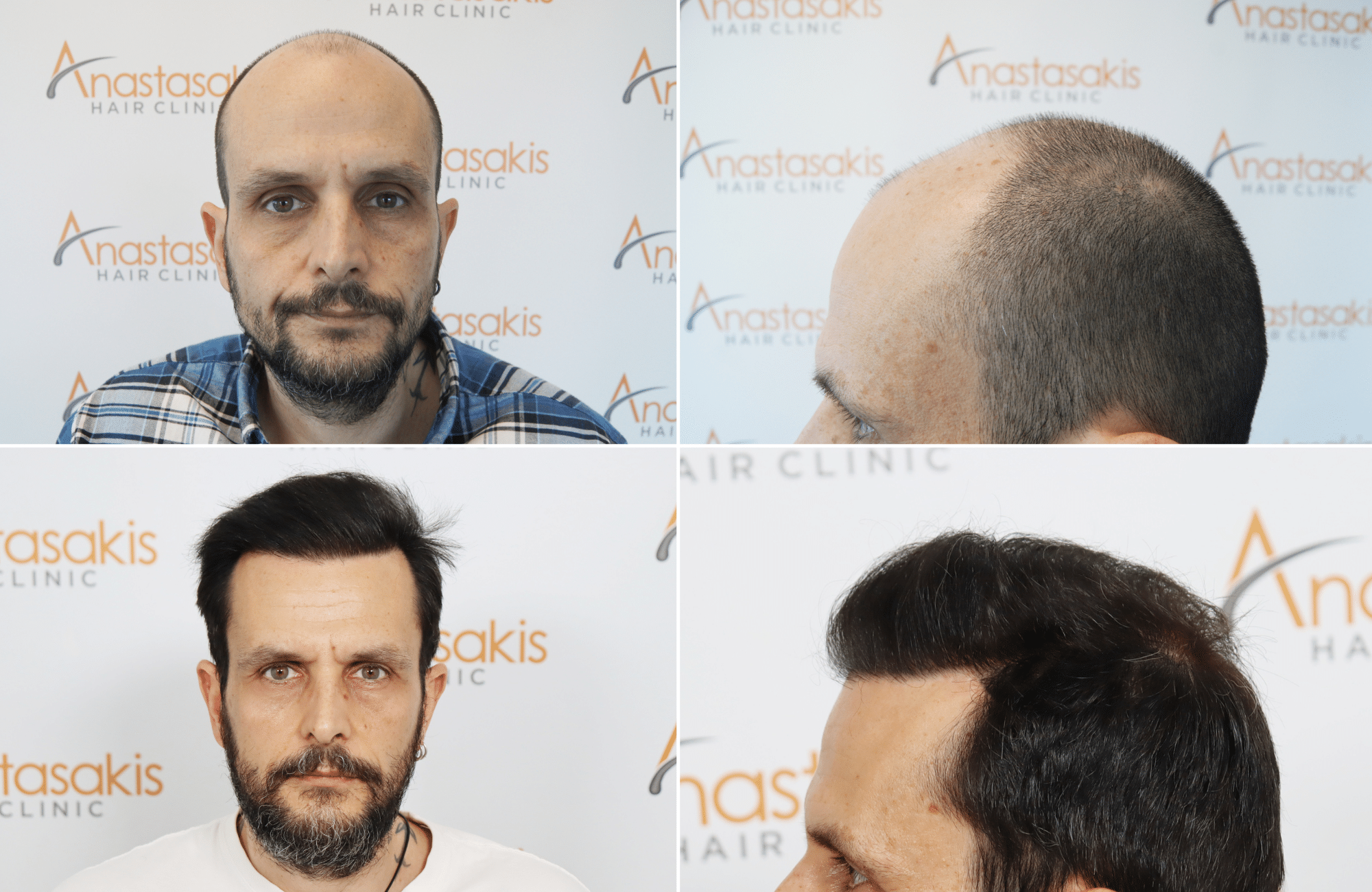 hair transplant result with 4800 follicular units by dr konstantinos anastassakis - 4 pics preview
