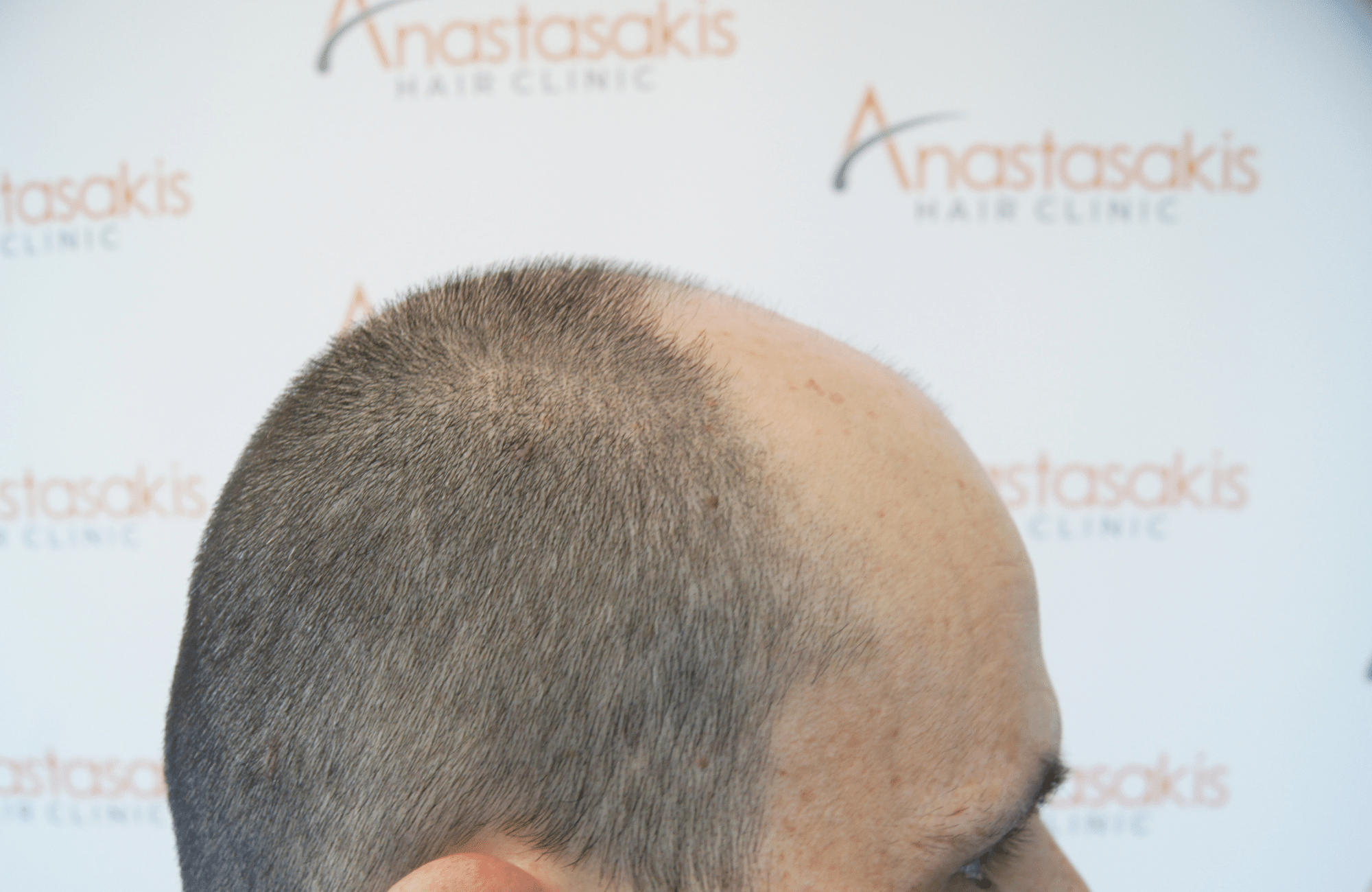 hair transplant result with 4800 follicular units by dr konstantinos anastassakis - side2 before