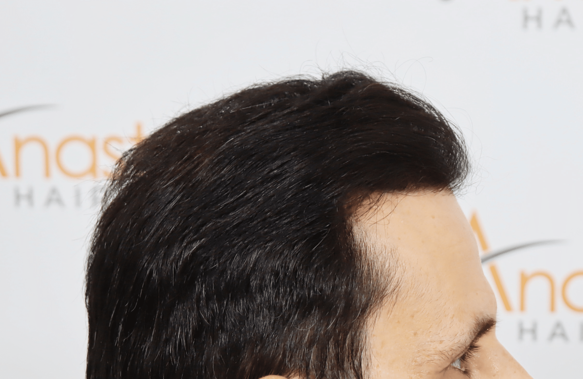 hair transplant result with 4800 follicular units by dr konstantinos - side2 after