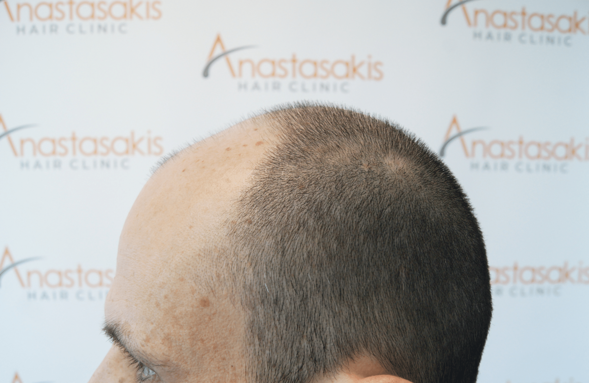 hair transplant result with 4800 follicular units by dr konstantinos anastassakis - side3 before