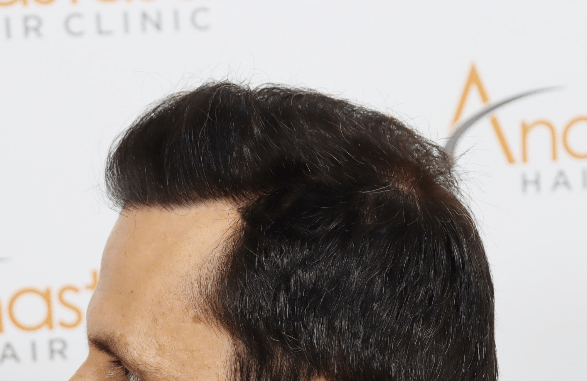 hair transplant result with 4800 follicular units by dr konstantinos anastassakis - side3 after