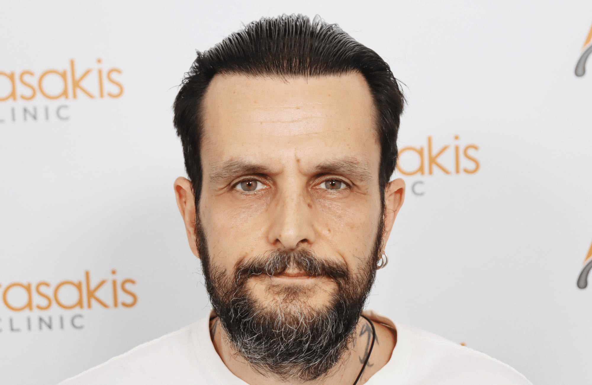 hair transplant result with 4800 follicular units by dr konstantinos anastassakis - fullface after wet look