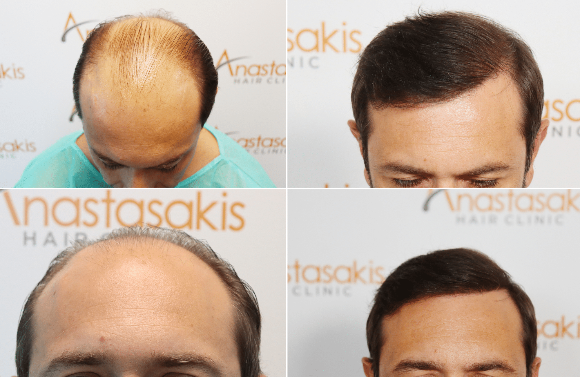 hair transplant result