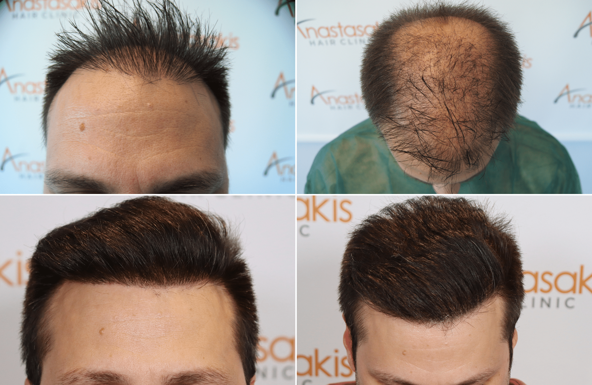 https://www.anastasakishairclinic.gr/portfolio/apotelesma-metamosxefsis-mallion-anastasakis-hair-clinic-166/