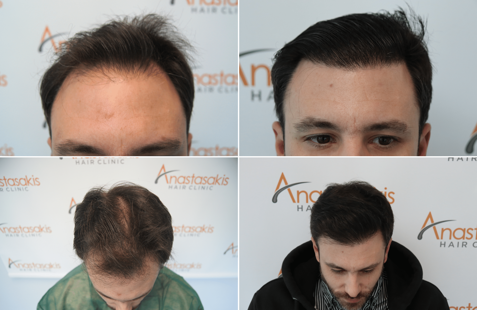 https://www.anastasakishairclinic.gr/portfolio/apotelesma-metamosxefsis-mallion-anastasakis-hair-clinic-346/
