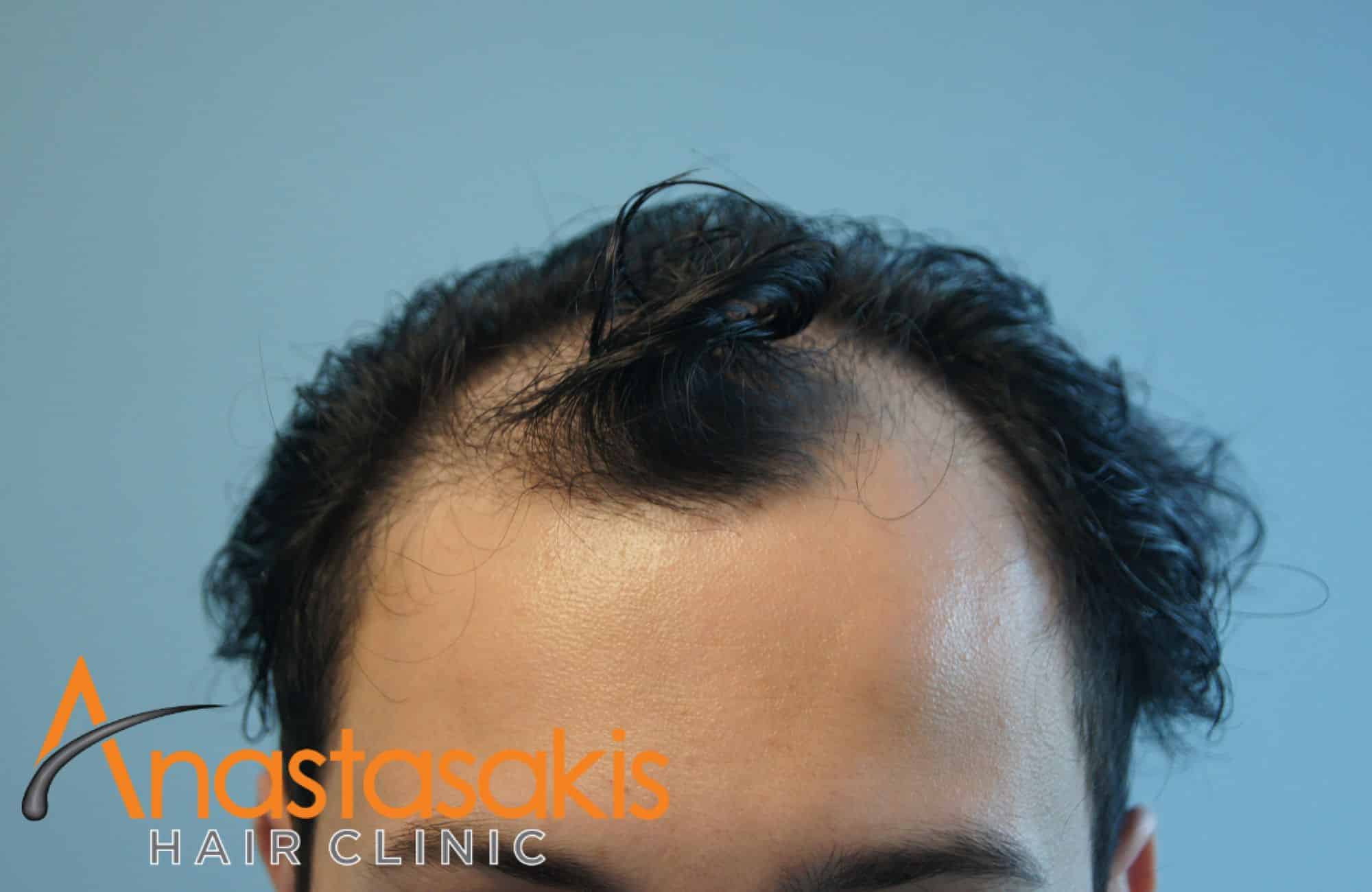 περιστατικο πριν τη μεταμόσχευση 1860 fus - hairline
