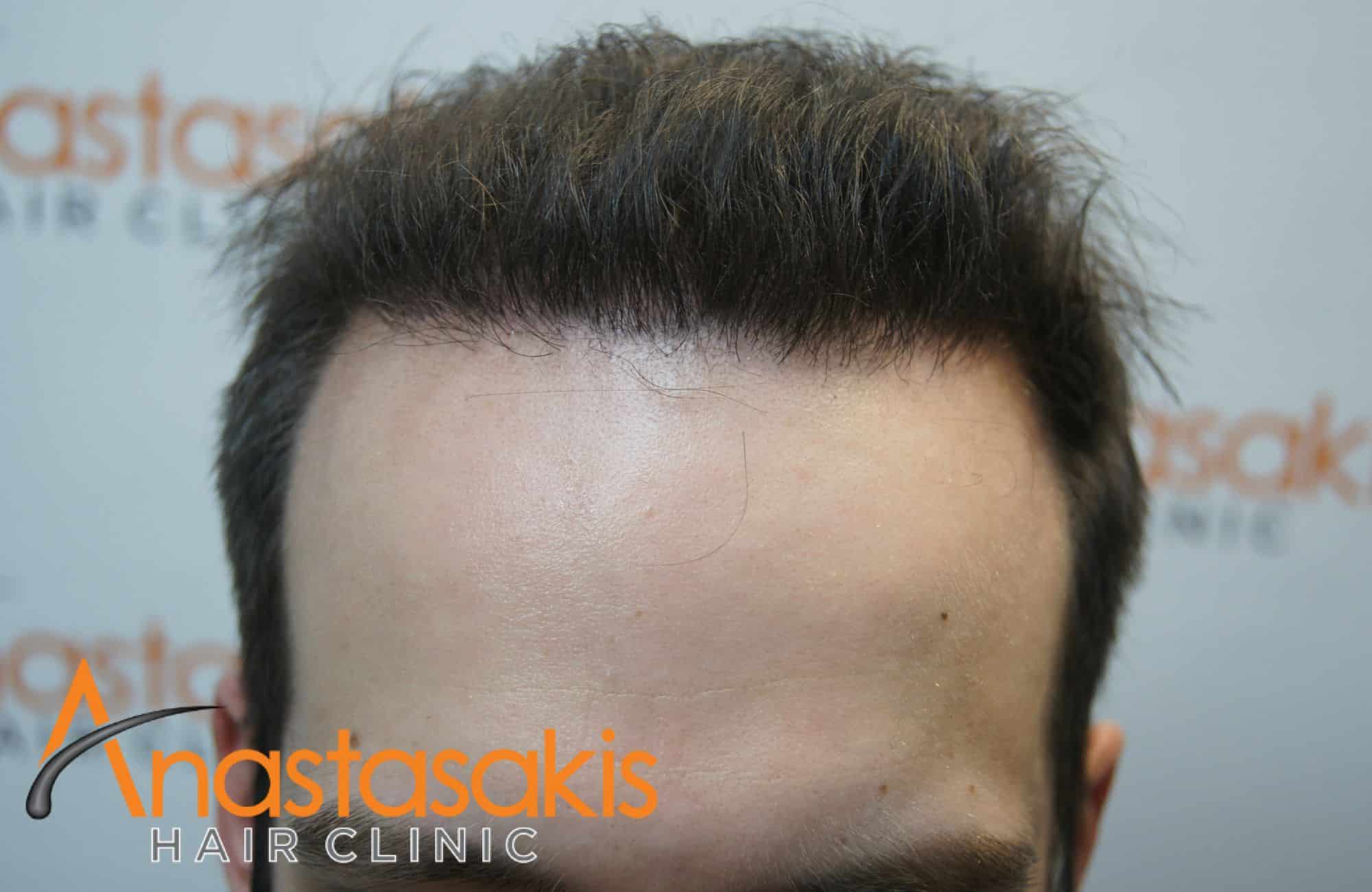 asthenis meta ti mm 2500fus hairline
