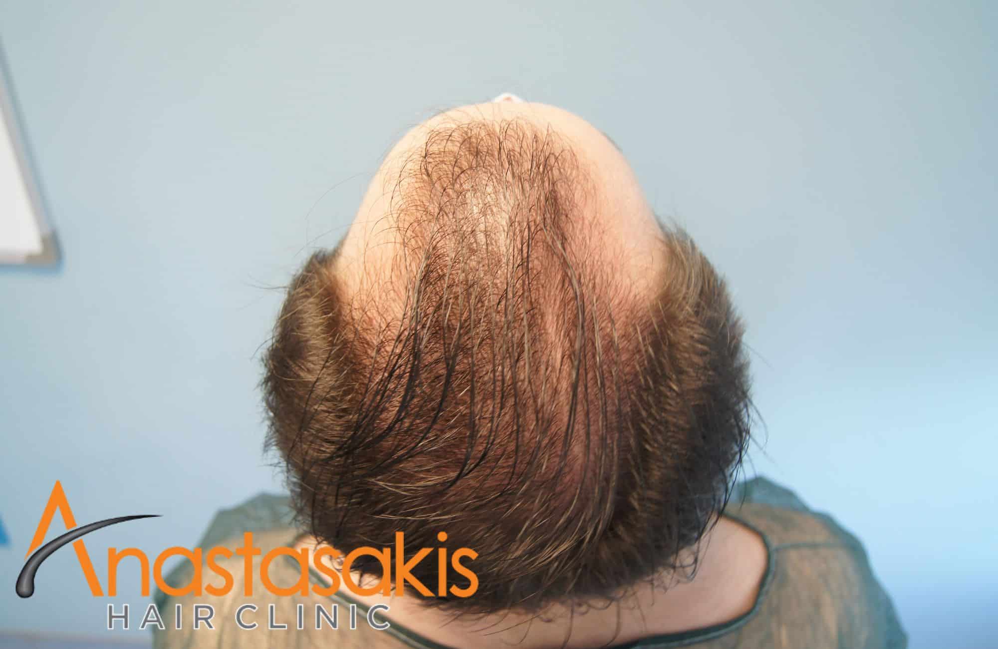 asthenis prin ti mm 2500fus back